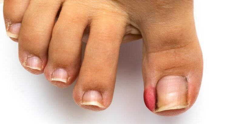 Prevent Ingrown Toenails